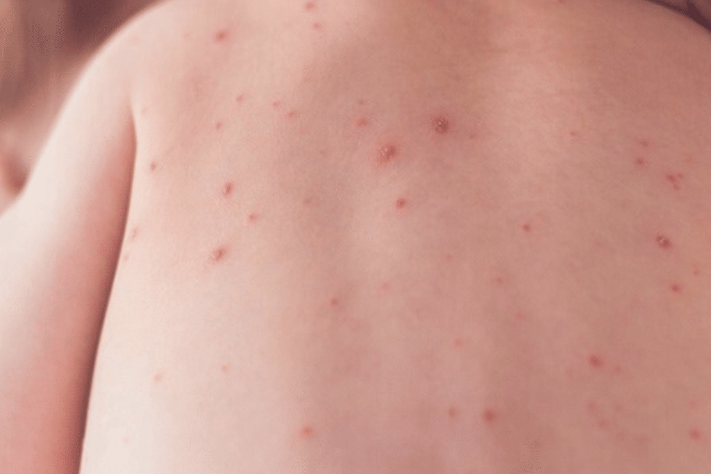 varicela yucatán,varicela,varicela en niños,varicela en adultos,varicela zoster,varicela en bebes,varicela en niños tratamiento,varicela gpc,varicela tratamiento,varicela vacuna,yucatán pediatría