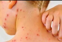 Sarampión se ha convertido en enfermedad reemergente: UNAM