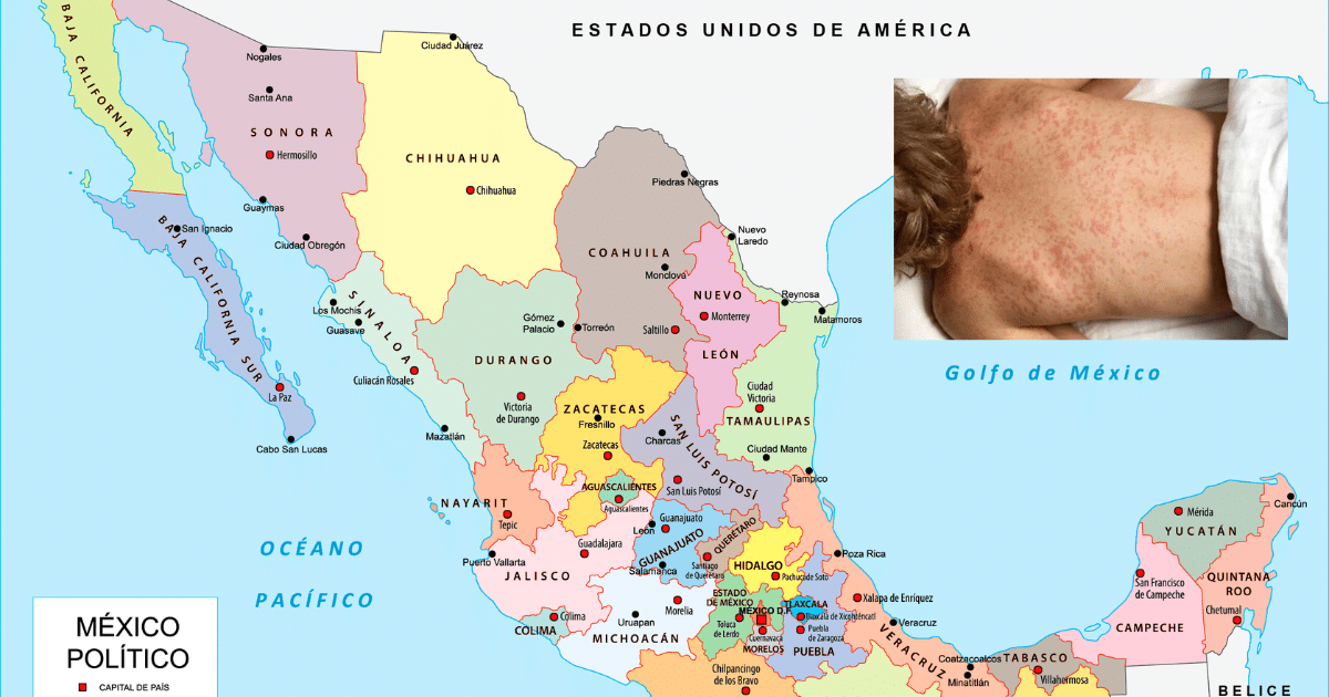 Aumentan los casos de sarampión en México 21 confirmados y más de 400 sospechosos