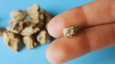 Yucatán, el estado donde se padece más por piedras en el riñón en México