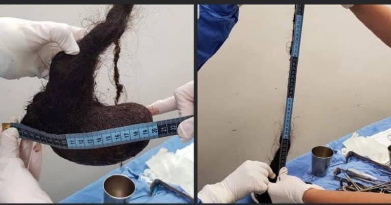 Extraen masa de cabello del estómago de una niña de 3 años en Yucatán
