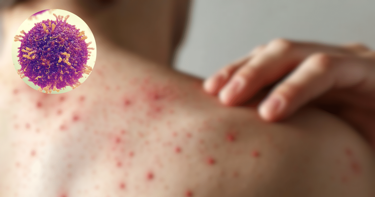 Crisis sanitaria México rebasa los 5,000 casos de sarampión y lidera la mortalidad en el continente