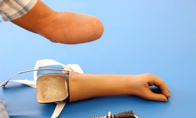 cropafy mejora la movilidad de yucatecos con entrega de prótesis y órtesis