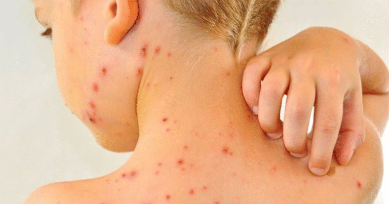 repunte temprano de varicela en yucatán enciende alerta sanitaria al inicio de 2026