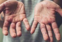 aumentan posibles casos de sarampión en yucatán durante 2026, confirman autoridades de salud