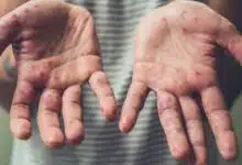 aumentan posibles casos de sarampión en yucatán durante 2026, confirman autoridades de salud