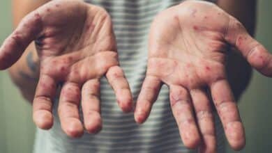 aumentan posibles casos de sarampión en yucatán durante 2026, confirman autoridades de salud