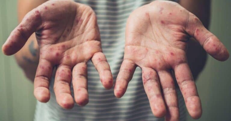 aumentan posibles casos de sarampión en yucatán durante 2026, confirman autoridades de salud