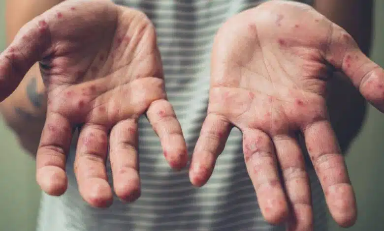 aumentan posibles casos de sarampión en yucatán durante 2026, confirman autoridades de salud