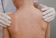 secretaría de salud confirma seis casos de sarampión en yucatán