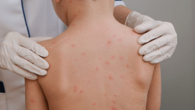 secretaría de salud confirma seis casos de sarampión en yucatán