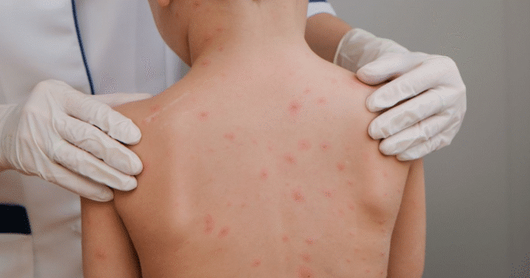 secretaría de salud confirma seis casos de sarampión en yucatán