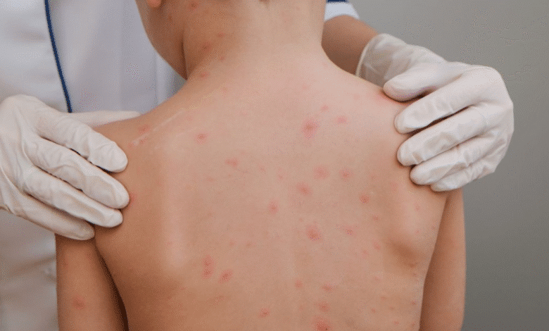 secretaría de salud confirma seis casos de sarampión en yucatán