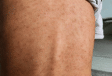 suman diez casos confirmados en yucatán de sarampión