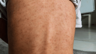 suman diez casos confirmados en yucatán de sarampión