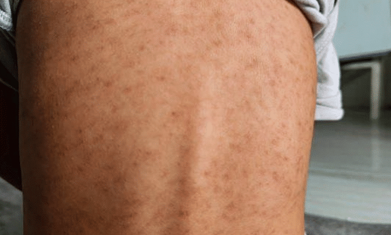 suman diez casos confirmados en yucatán de sarampión