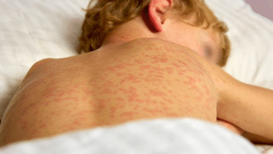 suman 17 casos de sarampión en yucatán y refuerzan vigilancia sanitaria