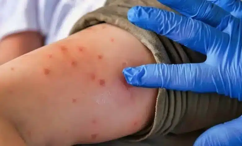 Yucatán registra 41 casos de sarampión