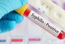 casos de sífilis aumentan 168% en yucatán durante 2026