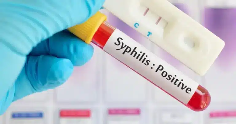 casos de sífilis aumentan 168% en yucatán durante 2026