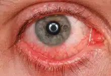conjuntivitis en vacaciones mitos que pueden aumentar los contagios durante la temporada de calor