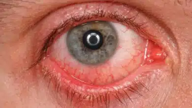 conjuntivitis en vacaciones mitos que pueden aumentar los contagios durante la temporada de calor