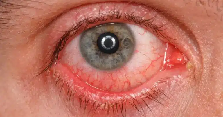 conjuntivitis en vacaciones mitos que pueden aumentar los contagios durante la temporada de calor