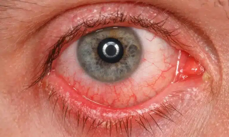 conjuntivitis en vacaciones mitos que pueden aumentar los contagios durante la temporada de calor