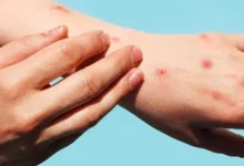 yucatán suma 23 casos de mpox salud pide aislarse ante primeros síntomas