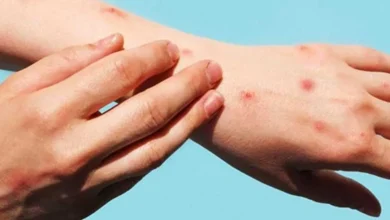 yucatán suma 23 casos de mpox salud pide aislarse ante primeros síntomas