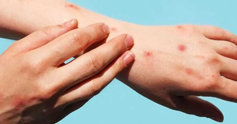 yucatán suma 23 casos de mpox salud pide aislarse ante primeros síntomas