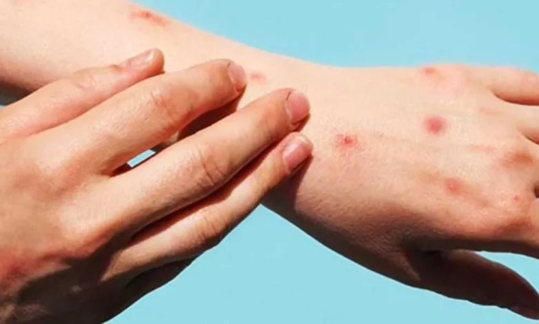 yucatán suma 23 casos de mpox salud pide aislarse ante primeros síntomas