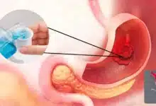 Científicos descubren cómo un simple enjuague bucal ayudaría a identificar el cáncer gástrico (Fotos internetredes)