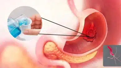 Científicos descubren cómo un simple enjuague bucal ayudaría a identificar el cáncer gástrico (Fotos internetredes)