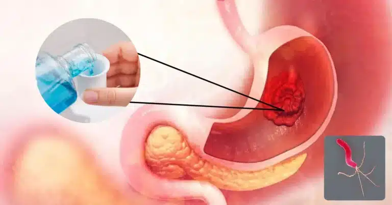Científicos descubren cómo un simple enjuague bucal ayudaría a identificar el cáncer gástrico (Fotos internetredes)