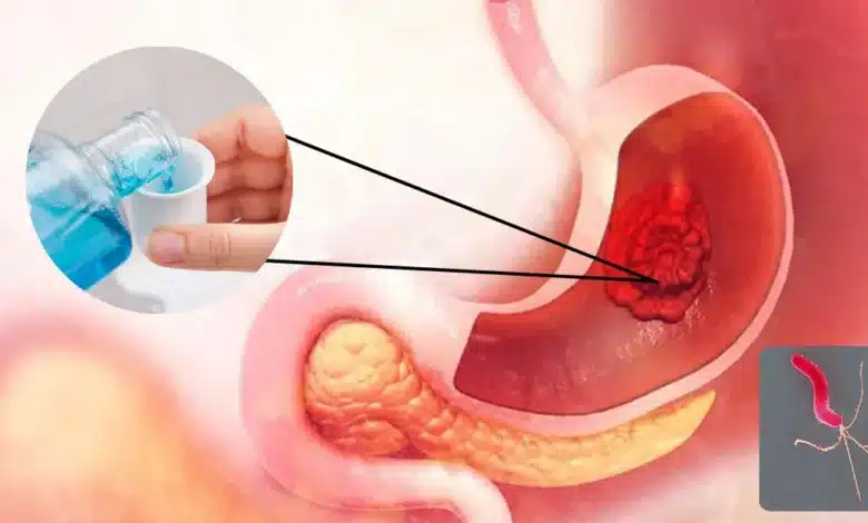 Científicos descubren cómo un simple enjuague bucal ayudaría a identificar el cáncer gástrico (Fotos internetredes)