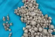 joven de 20 años llega con fiebre y médicos encuentran más de 300 piedras en un riñón