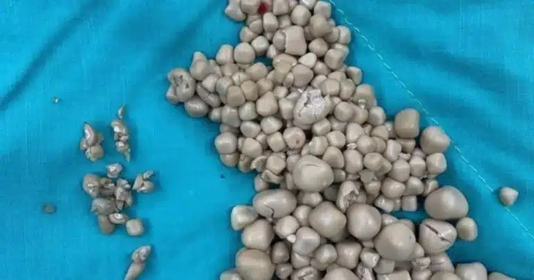 joven de 20 años llega con fiebre y médicos encuentran más de 300 piedras en un riñón