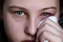 conjuntivitis se acerca a los 10 mil casos en yucatán