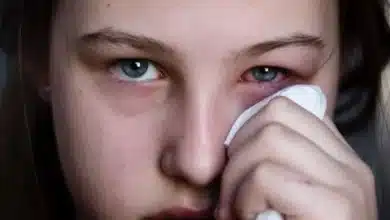 conjuntivitis se acerca a los 10 mil casos en yucatán
