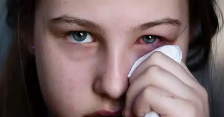 conjuntivitis se acerca a los 10 mil casos en yucatán