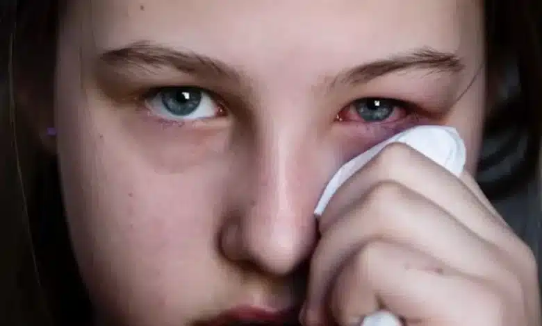 conjuntivitis se acerca a los 10 mil casos en yucatán