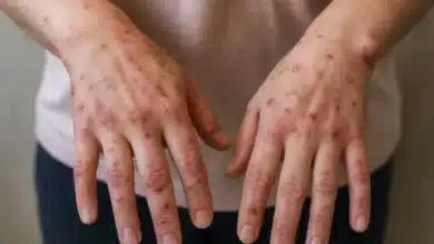 viruela símica aumenta 700 en yucatán ya son 24 casos y ocupa segundo lugar nacional