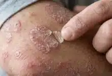 psoriasis afecta a una de cada 50 personas y puede causar daño articular