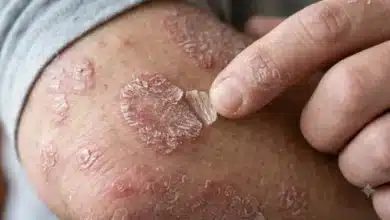 psoriasis afecta a una de cada 50 personas y puede causar daño articular
