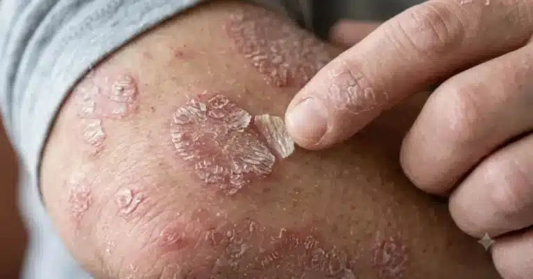 psoriasis afecta a una de cada 50 personas y puede causar daño articular