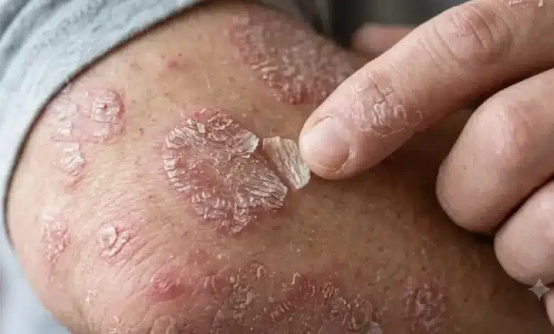 psoriasis afecta a una de cada 50 personas y puede causar daño articular
