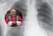 qué es el adenocarcinoma pulmonar, el tumor detectado al papa león xiv