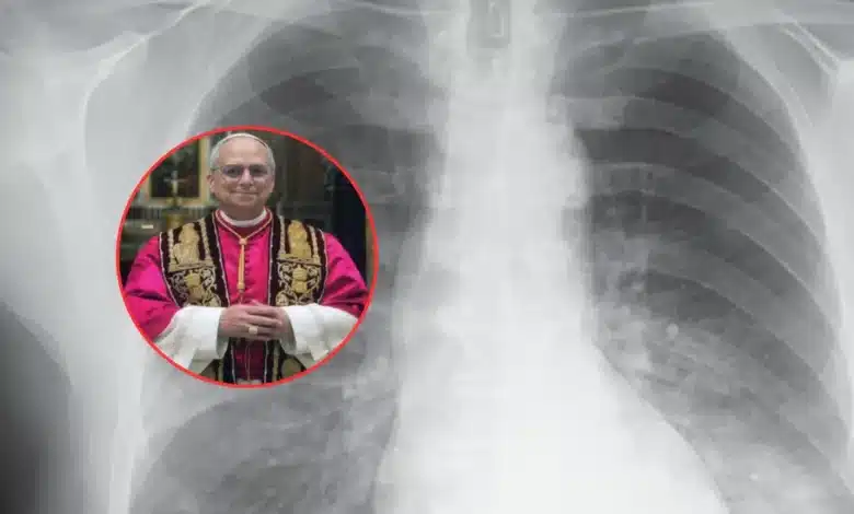 qué es el adenocarcinoma pulmonar, el tumor detectado al papa león xiv