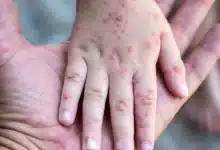 sarampión en méxico estados más afectados